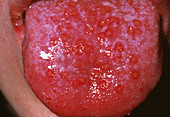 Herpes simplex viral blisters