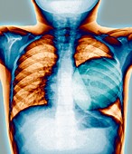 Cyst in a lung,chest X-ray