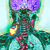 Cystic growth,MRI