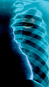 Hydropneumothorax,X-ray