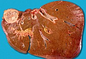 Hydatid cyst of liver