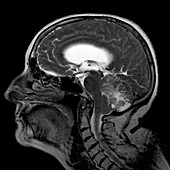 Haemangioblastoma brain tumour,MRI scan