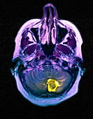 Haemangioblastoma brain tumour,MRI scan