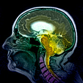 Haemangioblastoma brain tumour,MRI scan