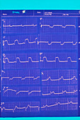 ECG pattern of person suffering a heart attack