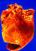 Post-mortem specimen of human heart