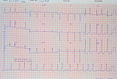 ECG showing aortic stenosis