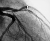 Angiogram of stenosis in left coronary artery