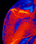 F/col coronary angiogram: stenosed artery