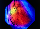 False-colour coronary angiogram: stenosis