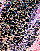 Light micrograph of cardiac muscle & fatty disease