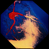 Coloured Angiogram of a coronary artery stenosis