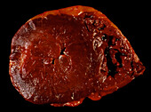 Gross specimen of heart,ventricular hypertrophy