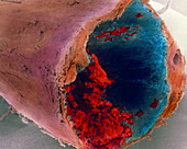 Coloured SEM of a blood clot in coronary artery