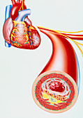 Illustration of heart with coronary thrombosis
