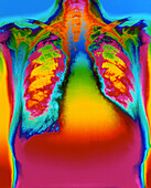 Colour X-ray of heart showing ventricular failure
