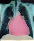 Coloured X-ray of chest showing enlarged heart