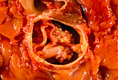 Gross specimen of a sub-aortic stenosis in heart