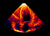 Coloured ultrasound scan of enlarged heart