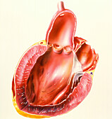 Illustration of heart after myocaridal infarction