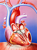 Artwork of a heart damaged by ischaemia