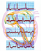 Cardiac arrhythmia with heart and ECGs