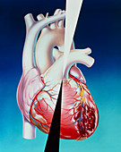 Artwork of heart attack due to atherosclerosis