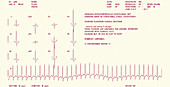 Heart disease ECG