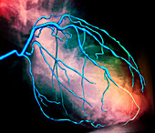 Heart disease,X-ray