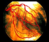 Heart disease,X-ray