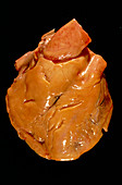 Heart fat deposits