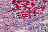 Diseased heart tissue,light micrograph