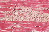 Inflamed heart tisue,light micrograph