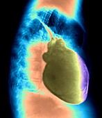 Heart inflammation,X-ray