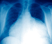 Enlarged heart,X-ray
