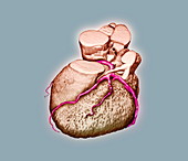 Heart disease,CT scan