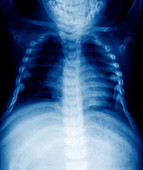 Fallot's tetralogy,X-ray