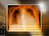 Heart failure,chest X-ray