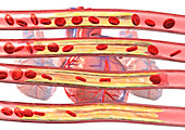 Coronary artery disease