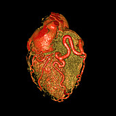 Enlarged coronary arteries