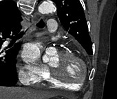 Heart bypass grafts,CT scan