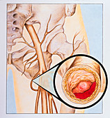 Illustration of leg deep vein thrombosis