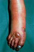Gangrenous foot due to deep vein thrombosis