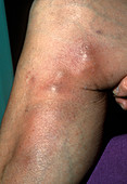 Phlebitis on the leg with thrombosis