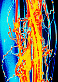 Coloured venogram of phlebitis in leg of patient