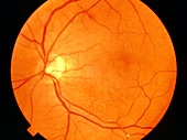 Ophthalmoscopy of occluded Branched Retinal Vein