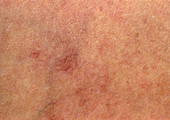 Skin of a patient suffering from telangiectasia
