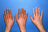 Hands with acrocyanosis compared to healthy hand