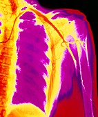 Coloured angiogram of embolus blocking arm artery