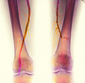 Blocked artery angiogram